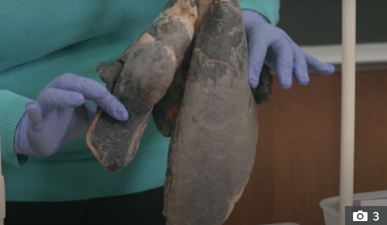 Experts reveal shocking difference between smoker's and non-smoker's lungs